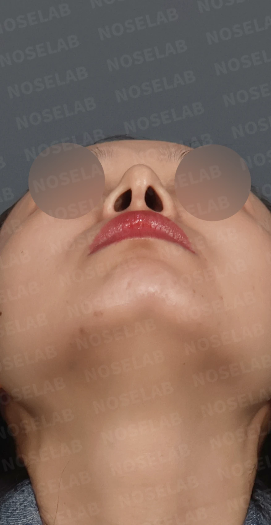 비공 비대칭과 휘어진 코, 자가늑연골 재건으로 교정한 코재수술 — 디자인 상담 우측 측면, 비스듬한 측면, 비공 사진