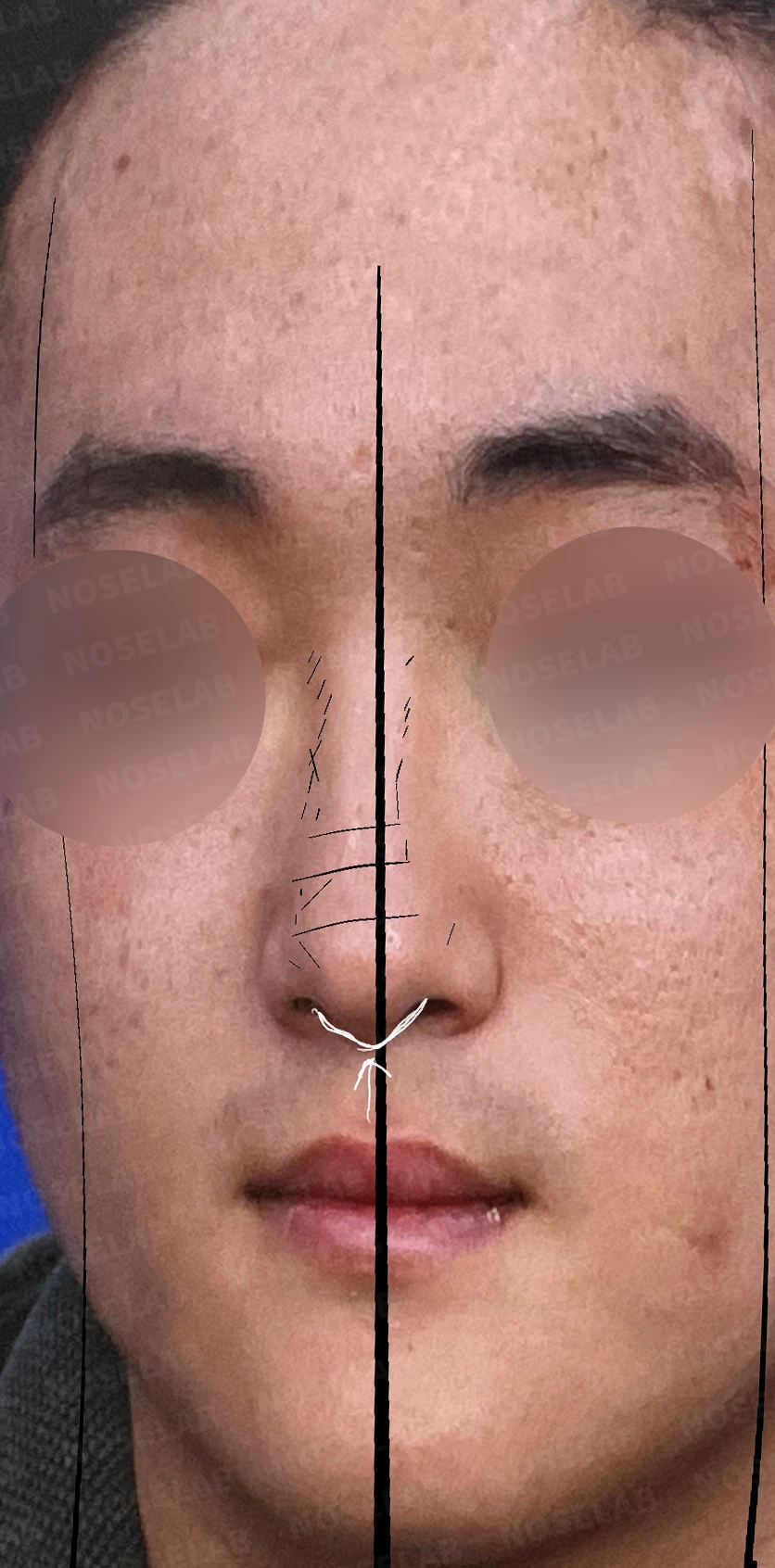 휜코 교정하면 안면 비대칭이 좋아질까요? — 수술 전 정면사진
