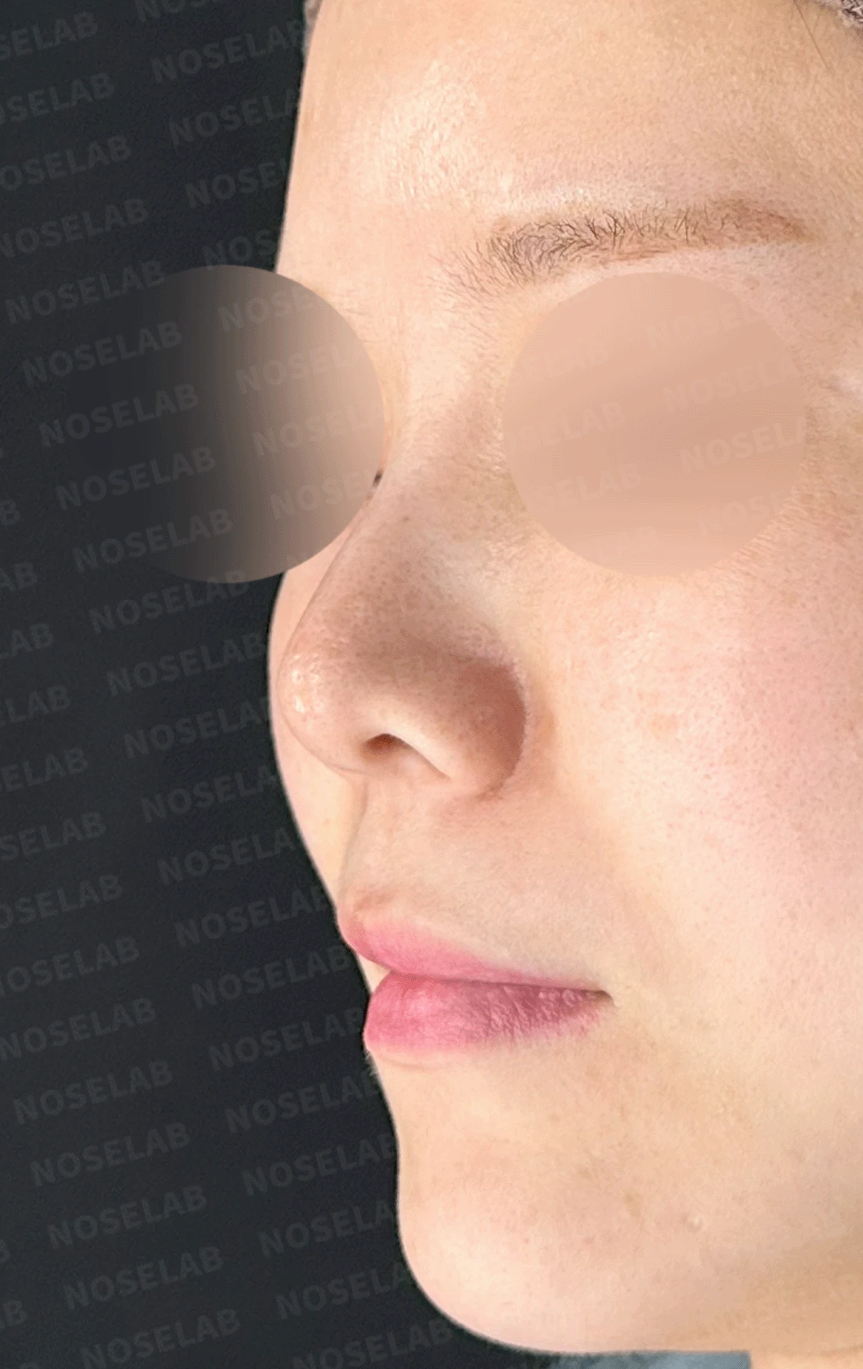 늑연골 석회화를 미리 확인해야 하는 이유와 휜코·짧은코 교정 방법 — 본문 사진 11