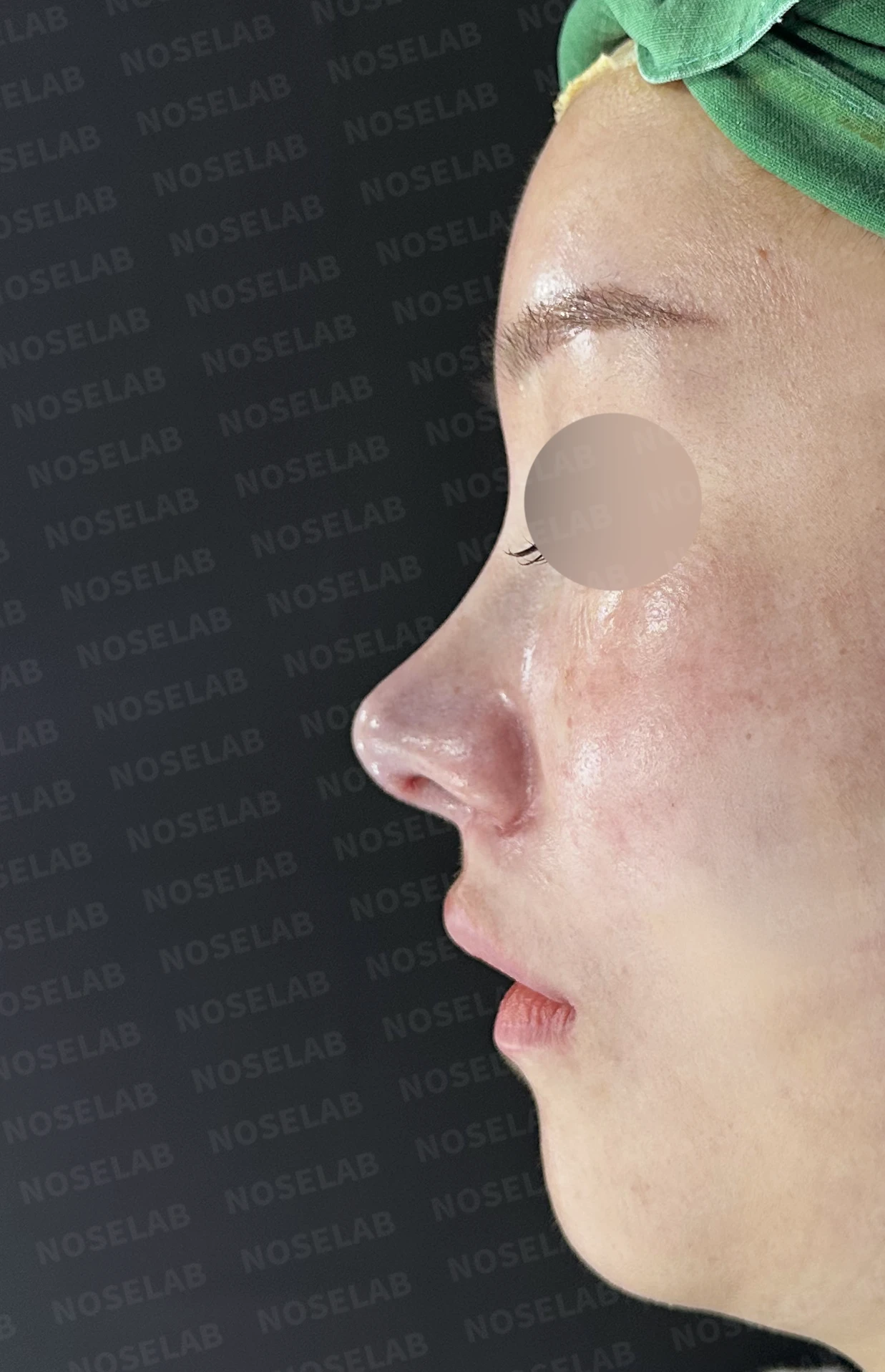 비주 함몰과 콧날개 변형, 자가늑연골을 이용한 코재수술로 자연스럽게 교정 — 직후 정면, 비스듬한 측면, 측면 사진입니다.
