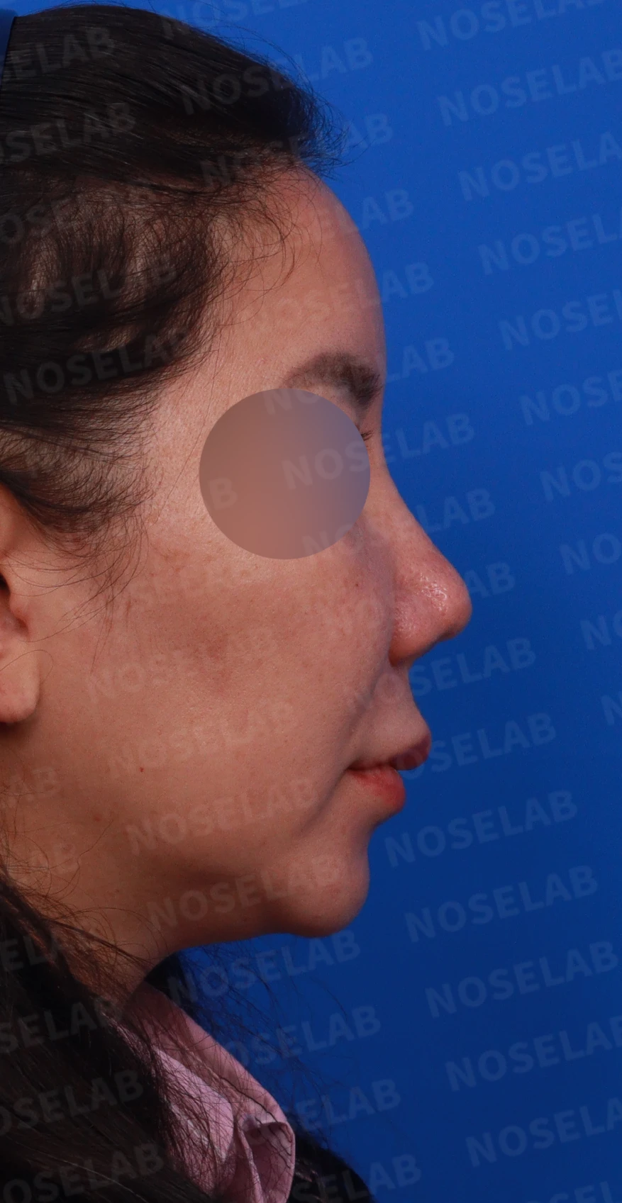 코끝이 찝히고 비주가 함몰되는 이유, 메드포어 제거와 재건은 어떻게 하나 — 디자인 상담 우측 비스듬한 측면, 측면, 비공 사진