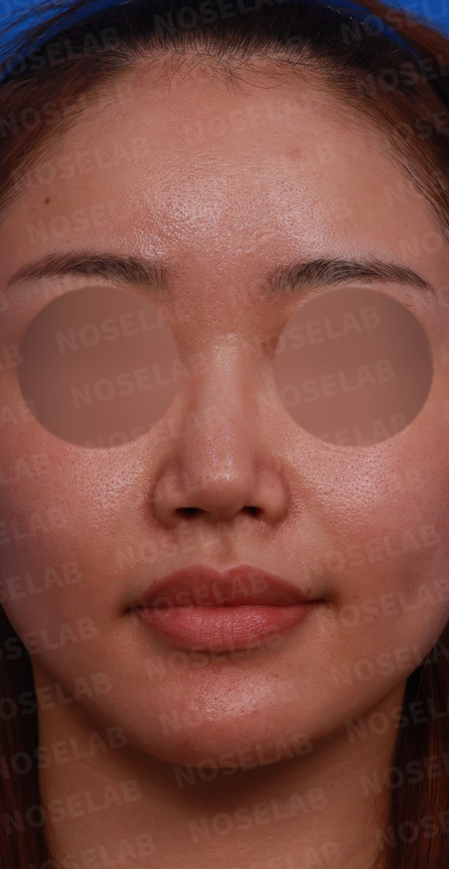 비공협착과 휜코, 코막힘을 함께 살펴보는 재수술 방법 — 디자인 상담 정면, 좌측 비스듬한 측면, 측면 사진