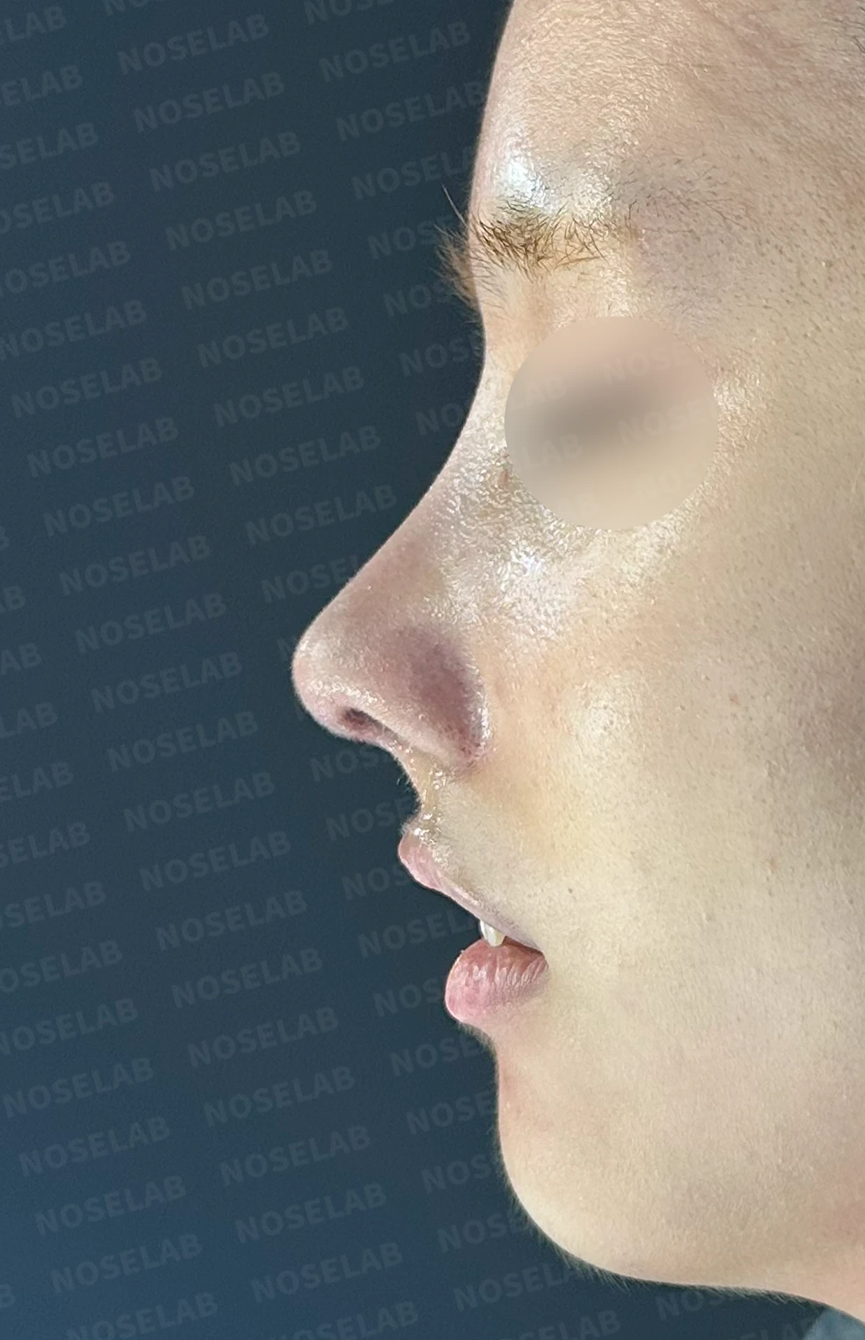 작고 뭉툭한 코는 어디까지 높일 수 있나 — 피부의 한계와 재건 방법 — 수술 전 / 수술 직후 0일 직후 사진은 부기가 있는 상태로 최종 결과와 다를 수 있습니다.