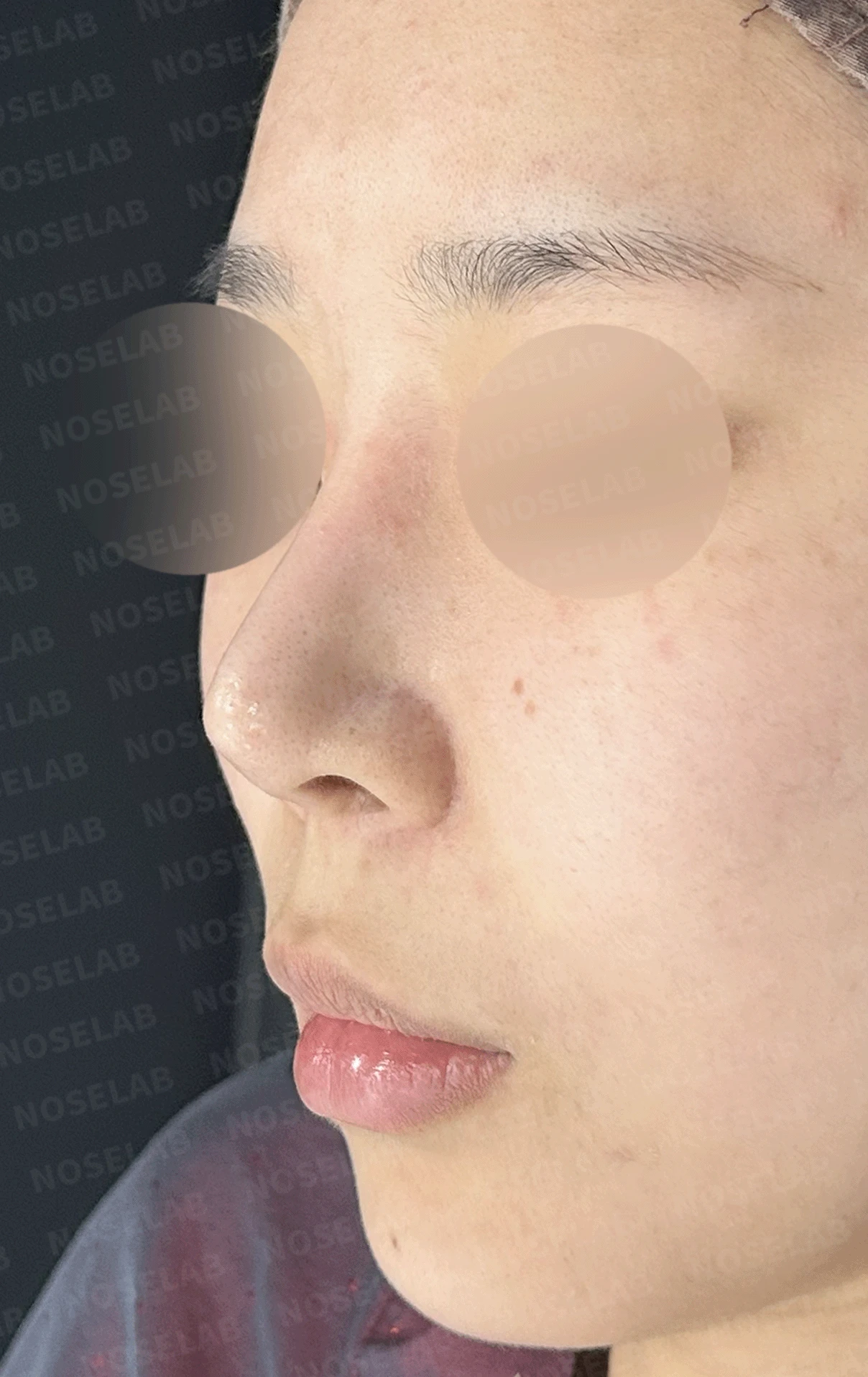 여러 번 수술한 코에 연골이 비치는 이유와 점막·구조 복원 방법 — 본문 사진 11