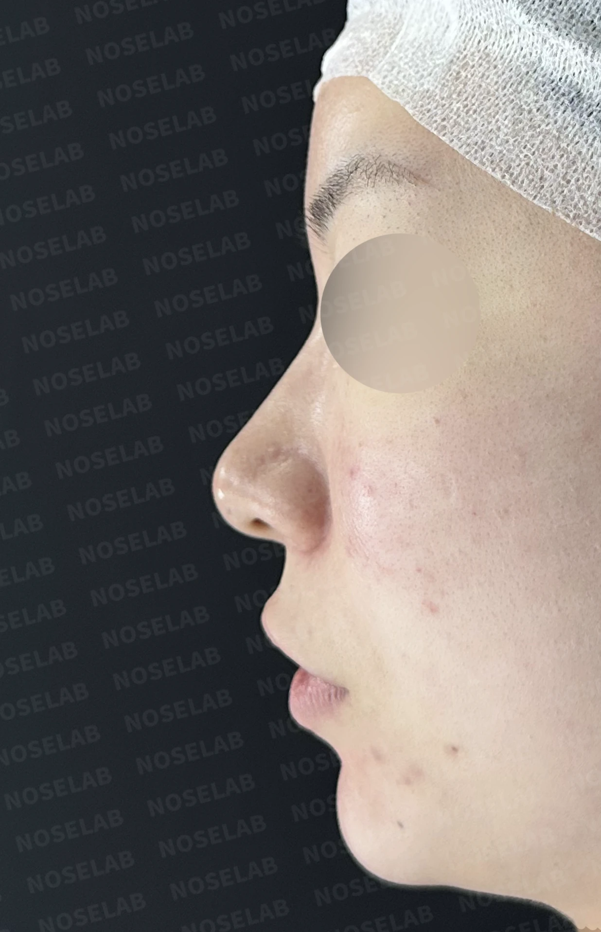 코끝이 퍼져 보이는 이유와 코바닥·비순각을 함께 다루는 방법 — 수술 전 / 수술 직후 0일 직후 사진은 부기가 있는 상태로 최종 결과와 다를 수 있습니다.