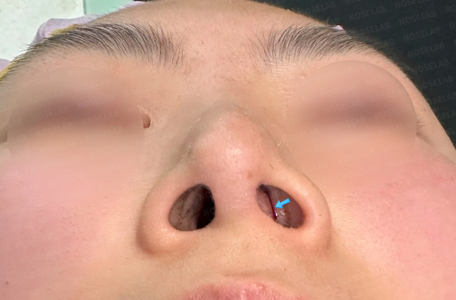 기능성 코성형·휘어진 비주 바로잡기 방법 — CT 소견상 좌측 콧구멍 안쪽 공간이 나오질 않는 소견과 콧구멍 사진에서 좌측 코 안쪽 공간이 거의 막혀 있는 모습을 관찰할 수 있습니다.