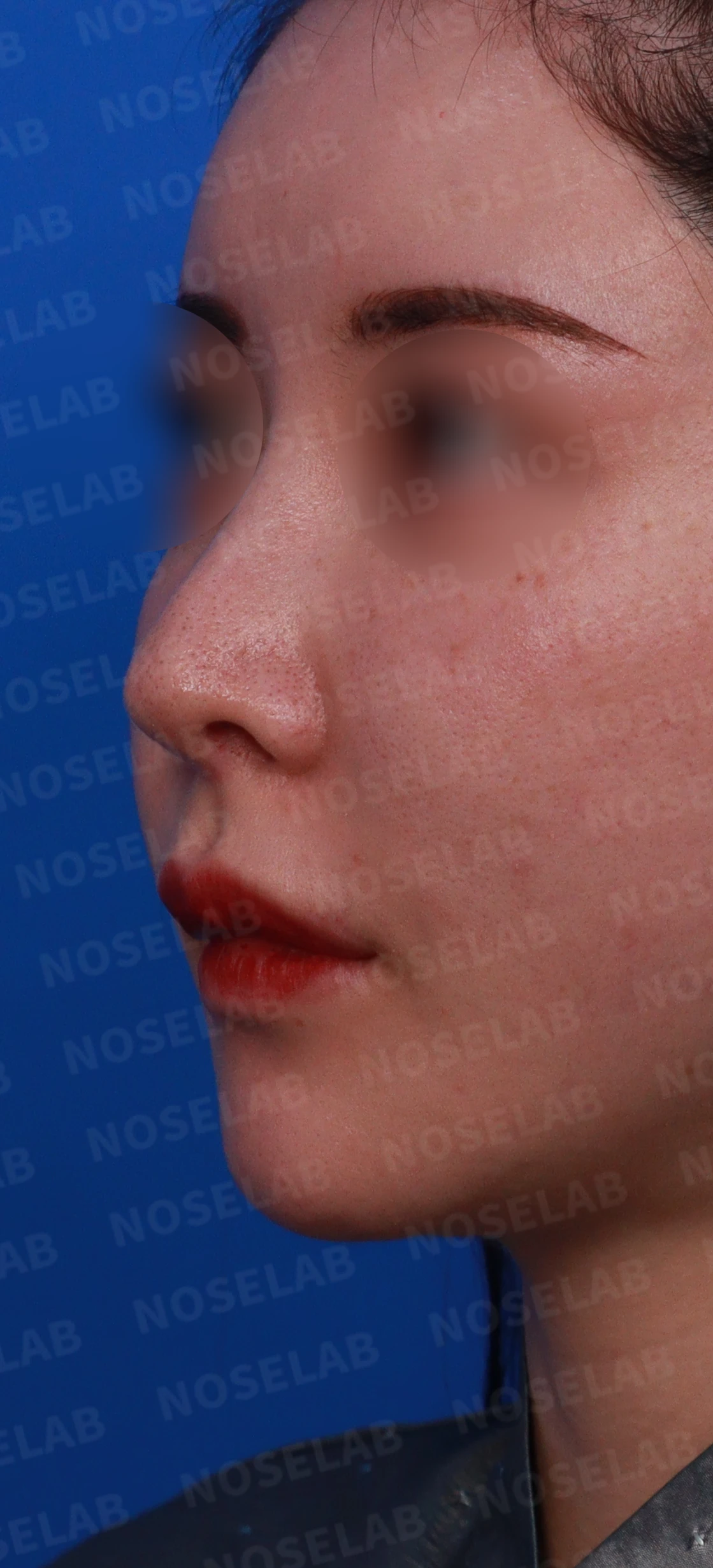 코막힘, 콧구멍비대칭 교정 사례 — 수술전 디자인 정면, 좌측 비스듬한 측면, 측면