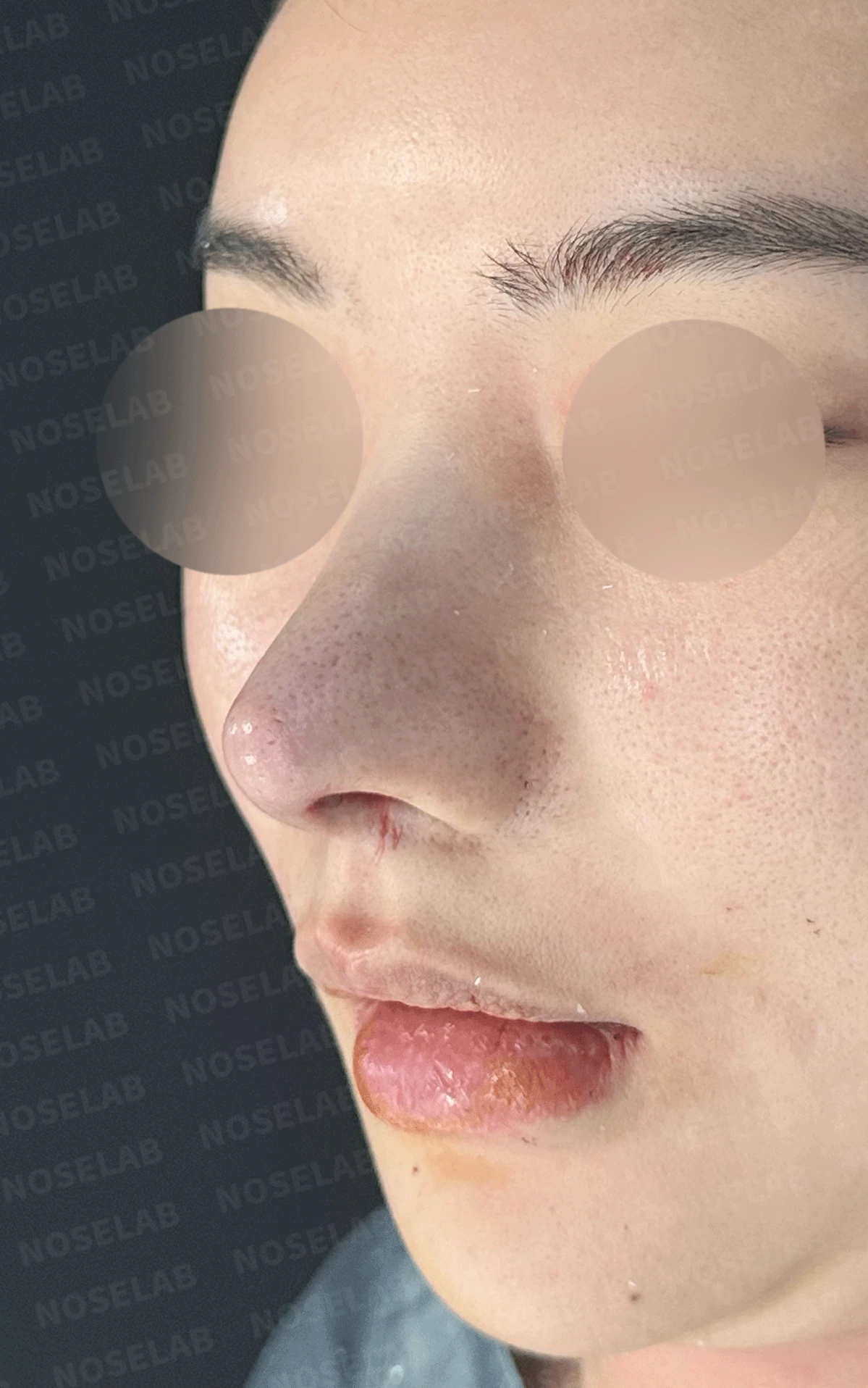 코가 과하게 높아져 부자연스러워 보이고 휘는 이유, 재건은 어떻게 하나 — 수술 직후 0일 정면 ,비스듬한 측면 , 측면 사진입니다. 직후 사진은 부기가 있는 상태로 최종 결과와 다를 수 있습니다.