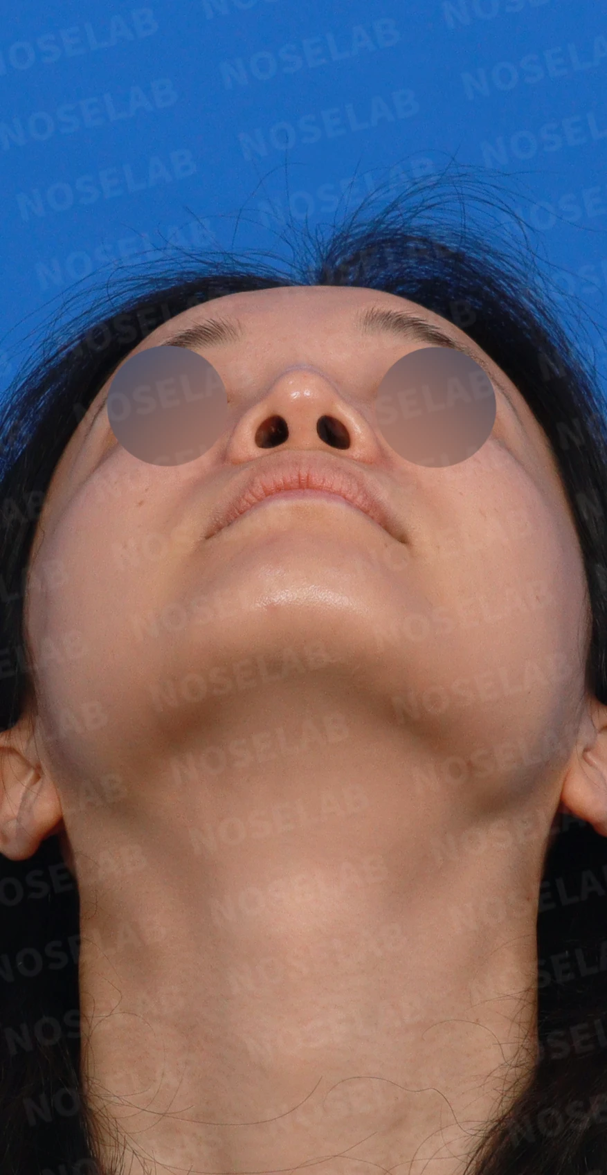 콧대 인공진피가 매부리로 남는 이유와 제거 후 재건 방법 — 디자인 상담 우측 측면, 비스듬한 측면, 비공 사진입니다.