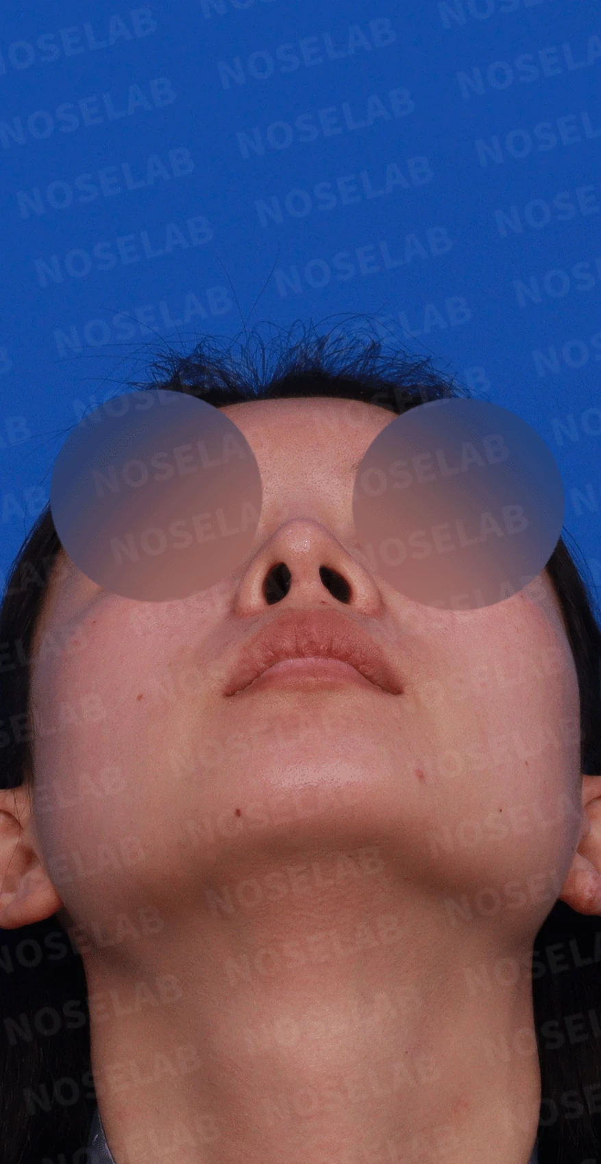 콧대가 인위적으로 보이고 코가 들리는 이유, 재건은 어떻게 하나 — 디자인 상담 비스듬한 측면 , 우측 측면, 비공 사진