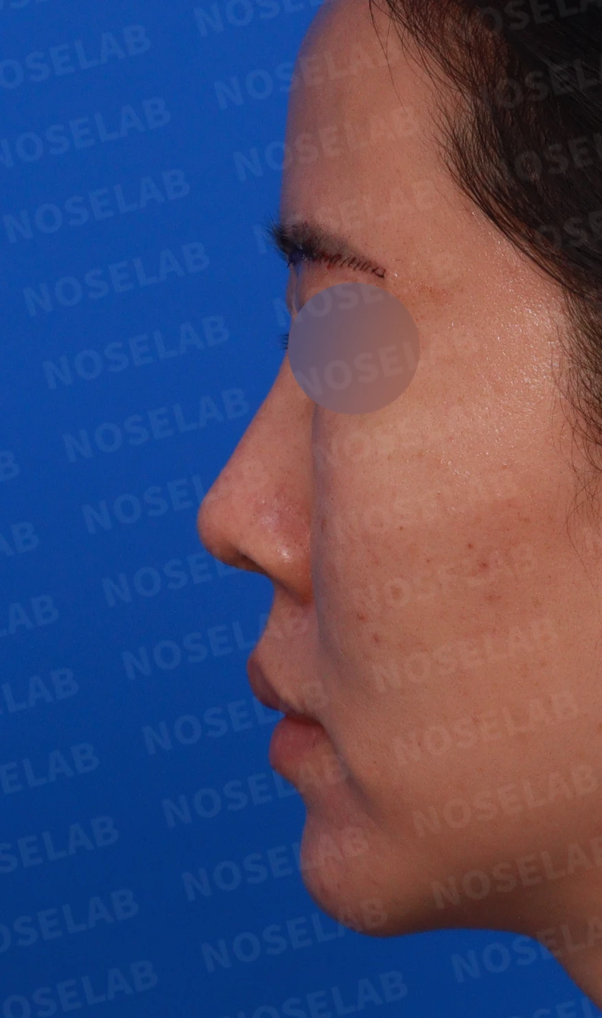 비주 내리기와 비순각 교정을 함께 계획하는 방법 — 디자인 상담 정면, 좌측 측면, 비스듬한 측면 사진입니다.