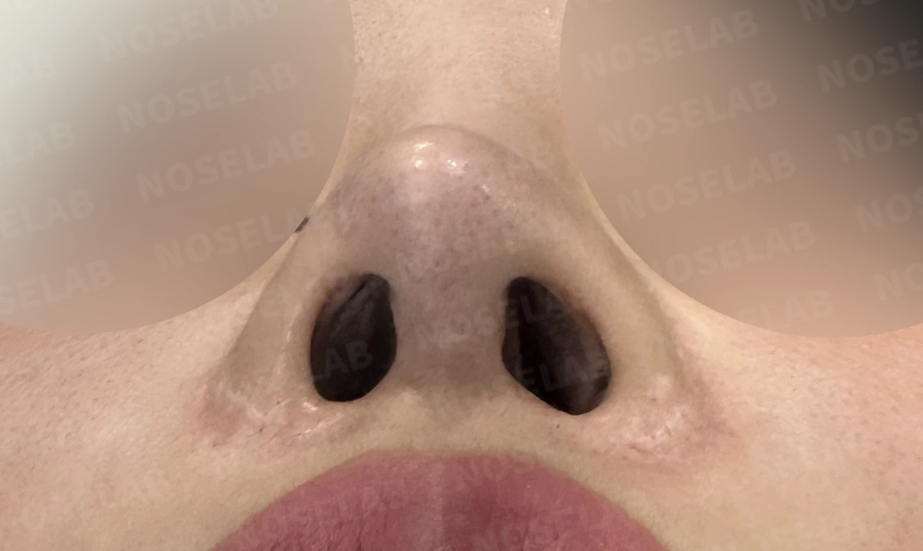 여러 차례 코 수술 뒤 내부 구조가 무너지는 이유와 늑연골 전체 재건 — 수술 전 / 수술 직후 0일 직후 사진은 부기가 있는 상태로 최종 결과와 다를 수 있습니다.