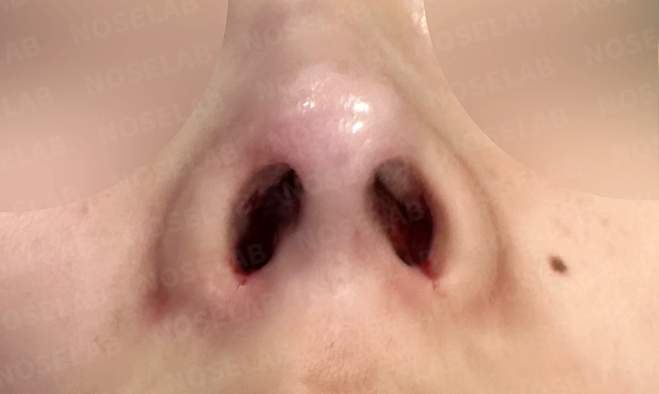 낮고 퍼진 코, 기증늑연골과 실리콘 보형물로 자연스러운 코 라인 완성 — 수술직후 비공 사진입니다.