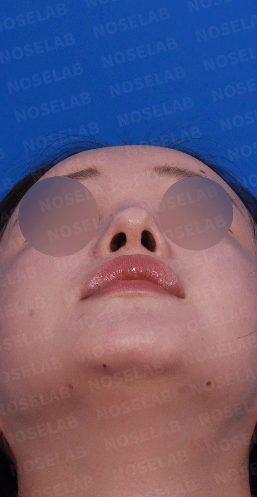 진피 이식 후 울퉁불퉁해진 콧대, 원인과 무보형물 재건 방법 — 디자인 상담 우측 측면 , 비스듬한 측면 , 비공 사진입니다.