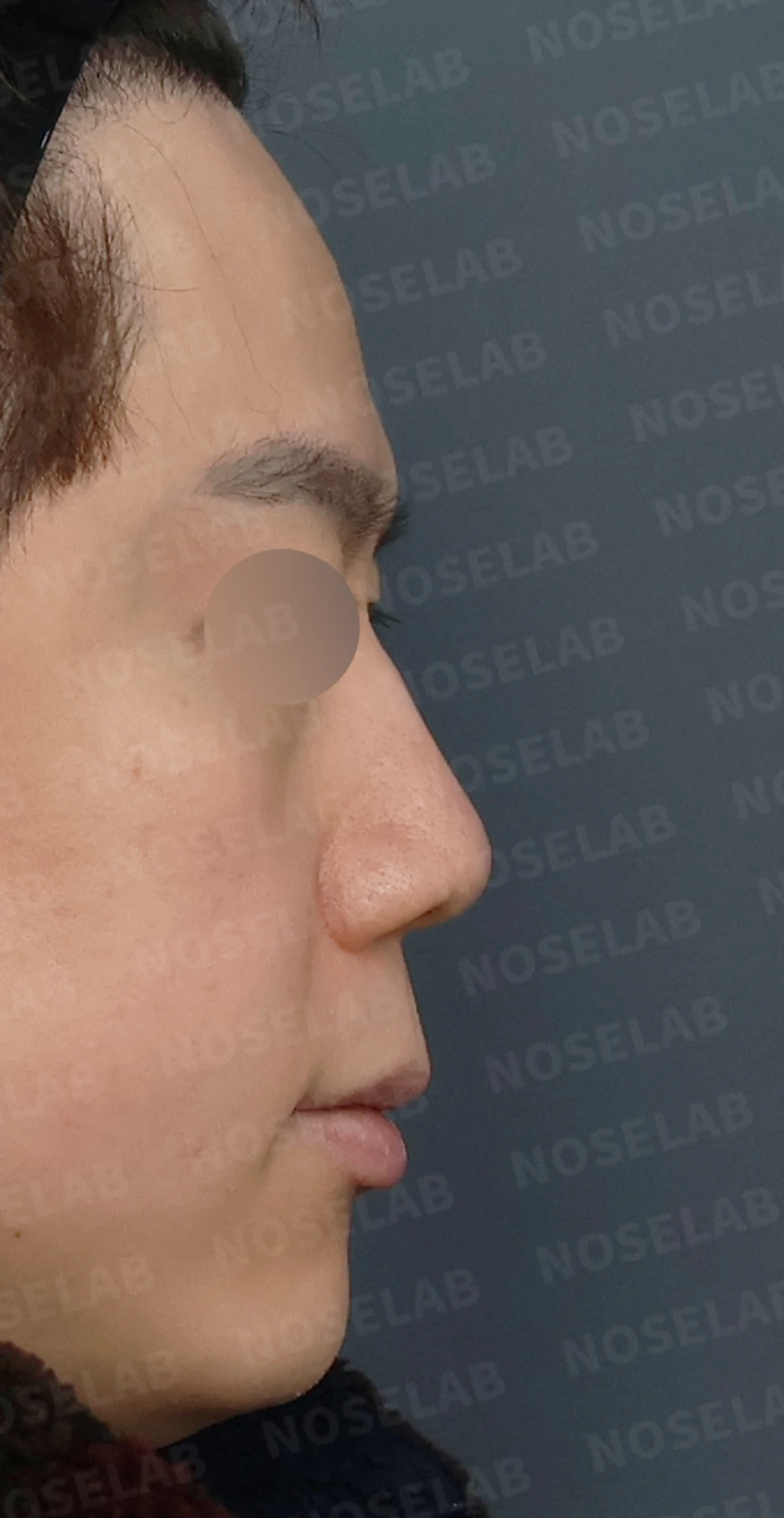 휘어진 매부리코, 자가늑연골로 교정한 남자 코성형 사례 — 본문 사진 4