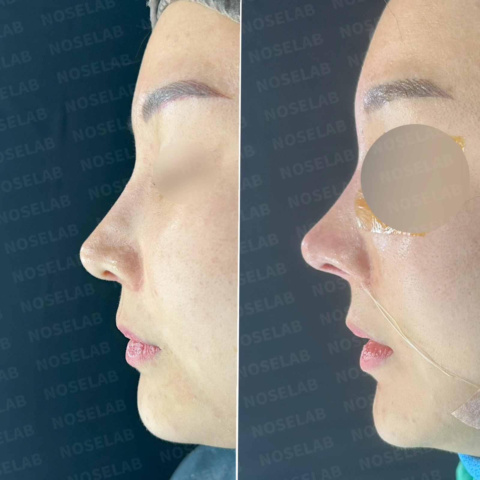 코가 휘어 보이고 비주가 한쪽으로 기우는 이유, 교정은 어떻게 하나 — 본문 사진 20