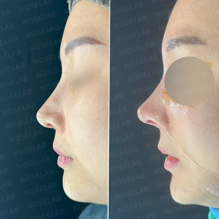 휘어진 코와 비주 비대칭 개선 - 세밀한 코 재수술 사례 — 전후 비교