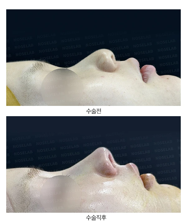 뭉툭한코와 돌출입 개선 방법 — 전후 비교