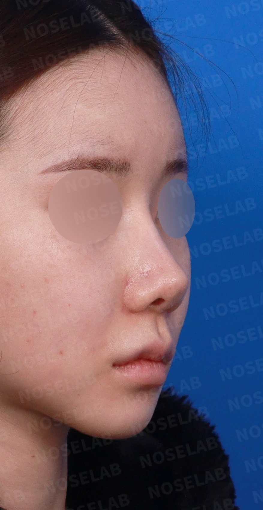 코성형 뒤 코끝이 들리고 비주가 짧아 보이는 이유, 비주 하강과 콧대 라인 교정 방법 — 디자인 상담 우측 측면, 비스듬한 측면, 비공 사진입니다.