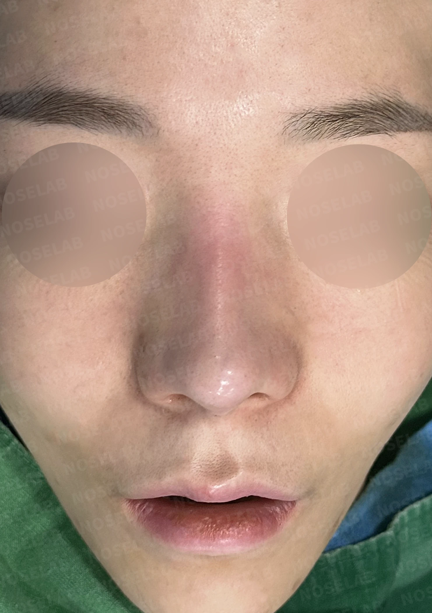 비주가 길어 보이는 이유와 코끝 연골 재배치 방법 — 수술 전 / 수술 직후 0일 직후 사진은 부기가 있는 상태로 최종 결과와 다를 수 있습니다.