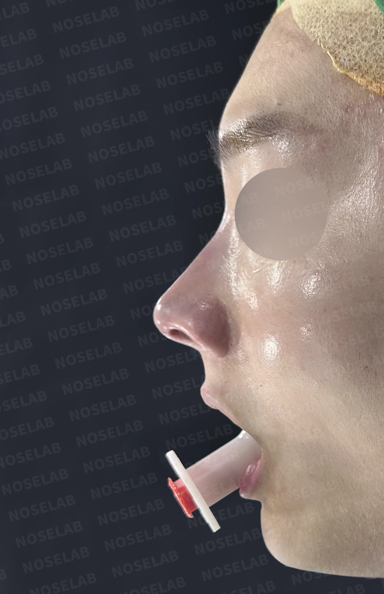 코가 낮아 보이는 이유와 자가 늑연골로 높이를 만드는 방법 — 수술 직후 0일 정면, 비스듬한 측면, 측면 사진입니다. 직후 사진은 부기가 있는 상태로 최종 결과와 다를 수 있습니다.