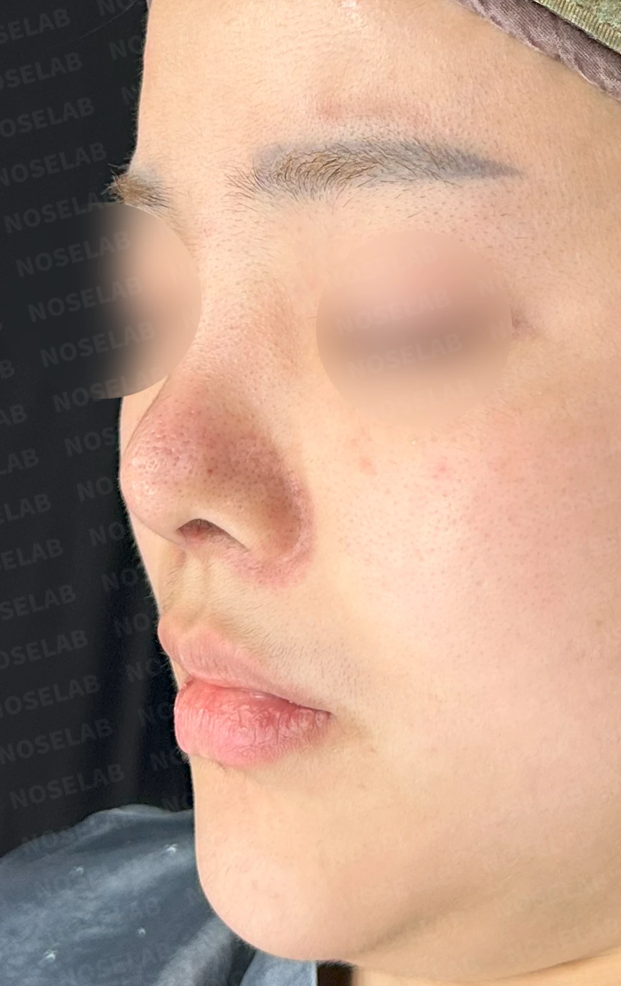 퍼진 콧대와 들린 코끝은 왜 생기나, 늑연골 재건은 어떻게 하나 — 수술 전 / 수술 직후 0일 직후 사진은 부기가 있는 상태로 최종 결과와 다를 수 있습니다.