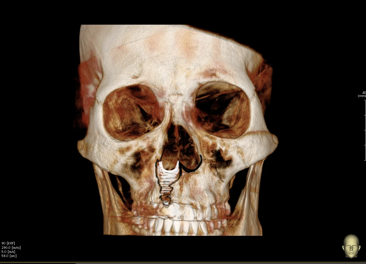 구순구개열에 동반된 코 변형의 교정 방법 — 1.오른쪽 바닥 뼈가 함몰되어 있는 사진 2. 자가늑연골을 이용하여 채워줄 예상도입니다.
