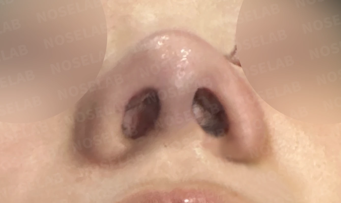 들린 코와 한쪽만 찝힌 콧구멍이 생기는 이유, 무보형물 재건은 어떻게 하나 — 수술 전 / 수술 직후 0일 직후 사진은 부기가 있는 상태로 최종 결과와 다를 수 있습니다.