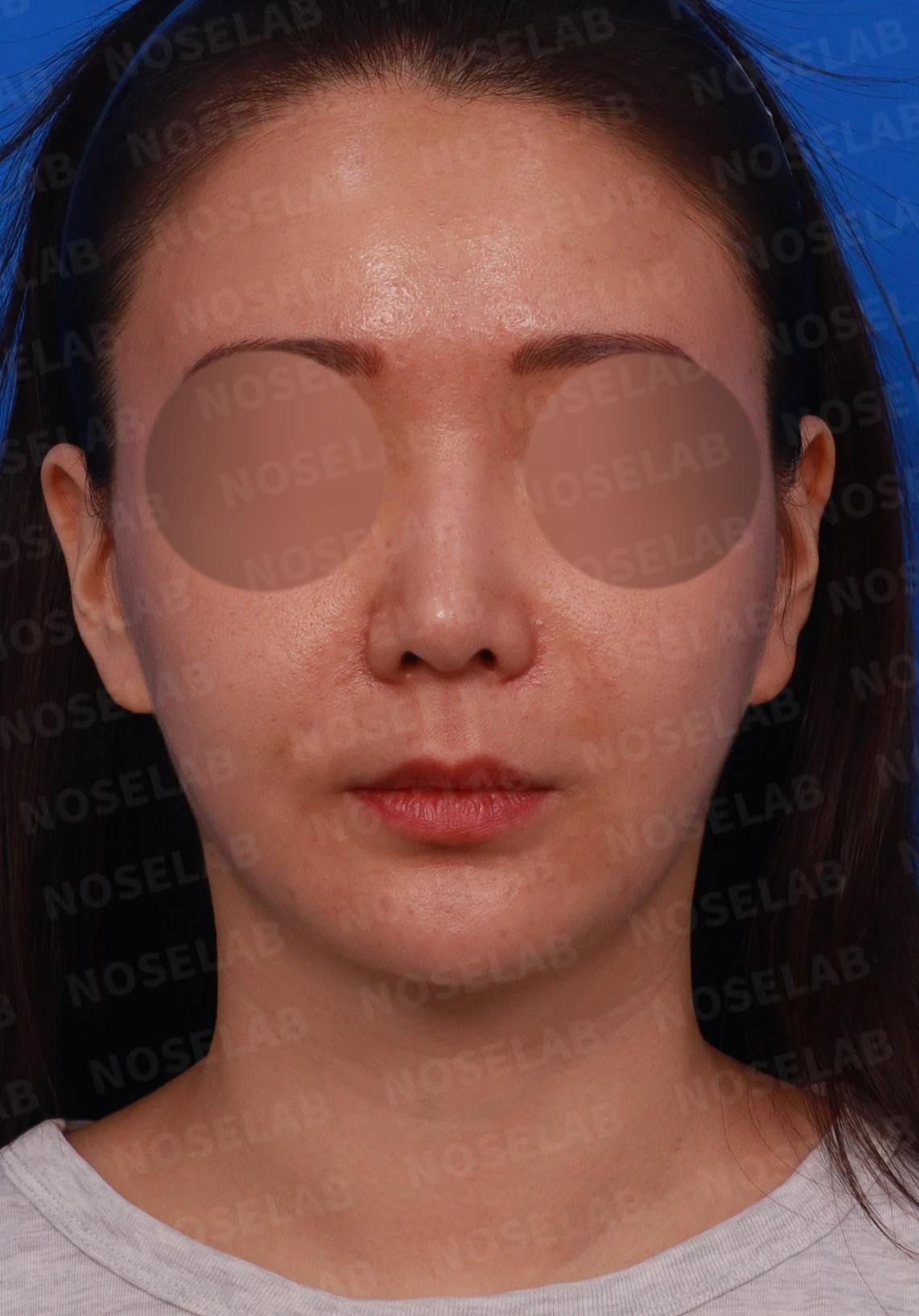 코가 휘어 보이고 비주가 한쪽으로 기우는 이유, 교정은 어떻게 하나 — 디자인 상담 정면, 좌측 측면, 비스듬한 측면 사진