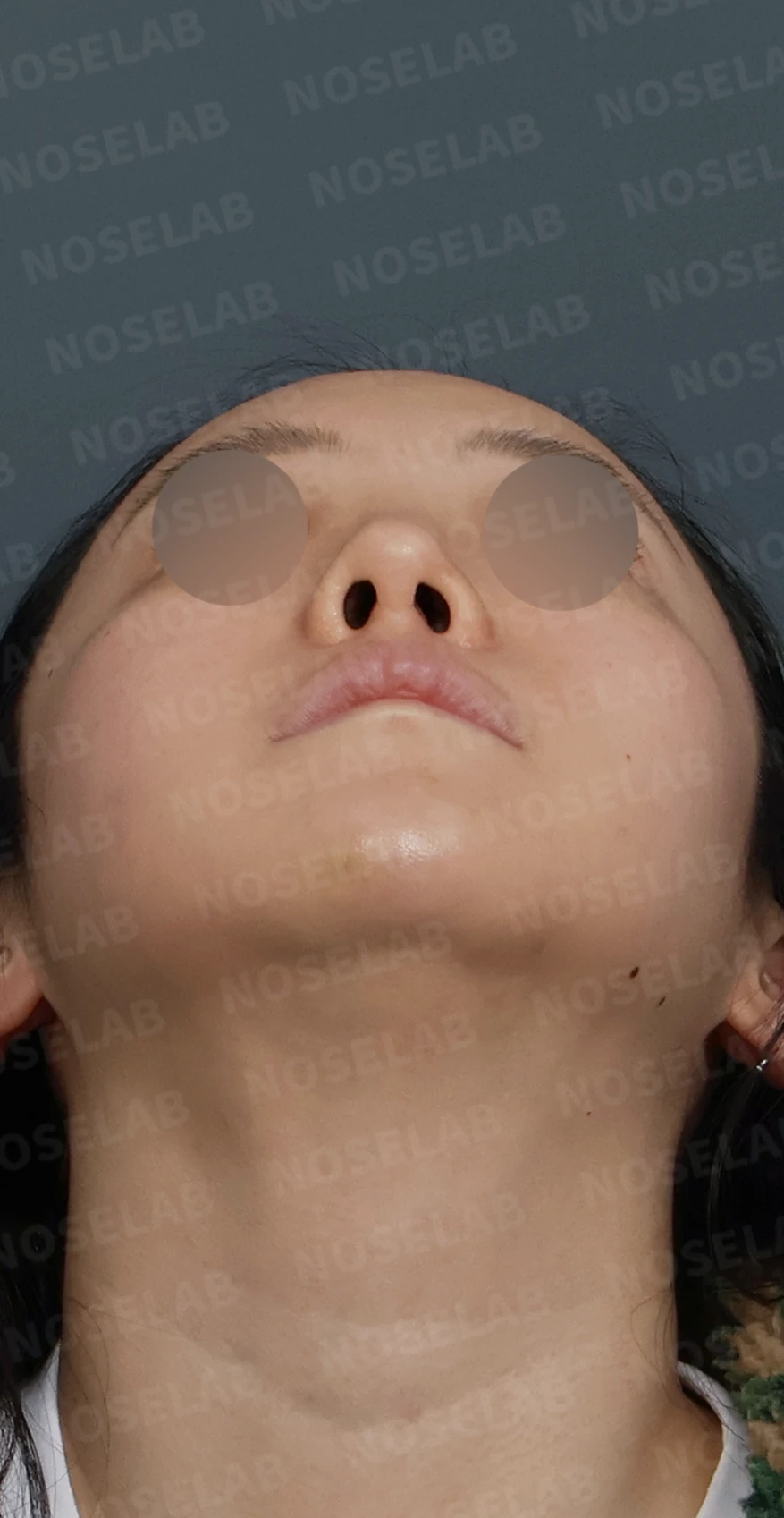 들린코 교정과 코막힘 개선, 자가늑연골로 코재수술 후기 — 디자인 상담 우측 측면, 비스듬한 측면, 비공 사진입니다.