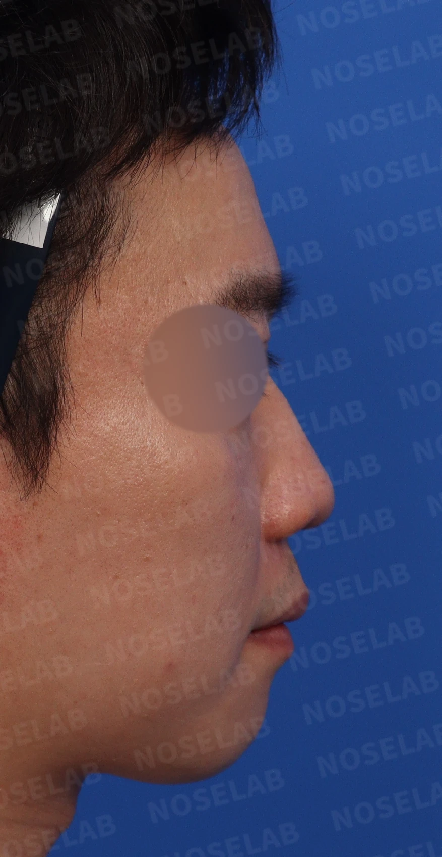 복코와 퍼진 코의 코성형 방법 — 디자인 상담 때 찍은 정면, 측면, 비스듬한 측면 사진입니다.