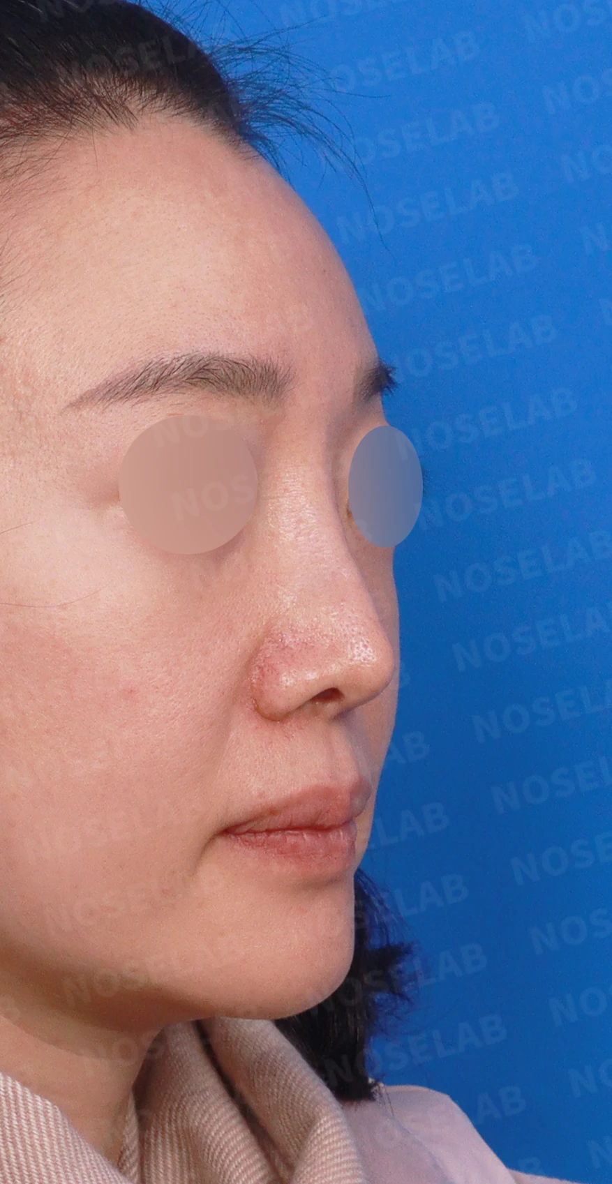 비중격이 한쪽으로 무너지면 코가 휘고 숨이 막히는 이유, 자가늑연골 재건 방법 — 디자인 상담 우측 측면, 비스듬한 측면, 비공 사진입니다.