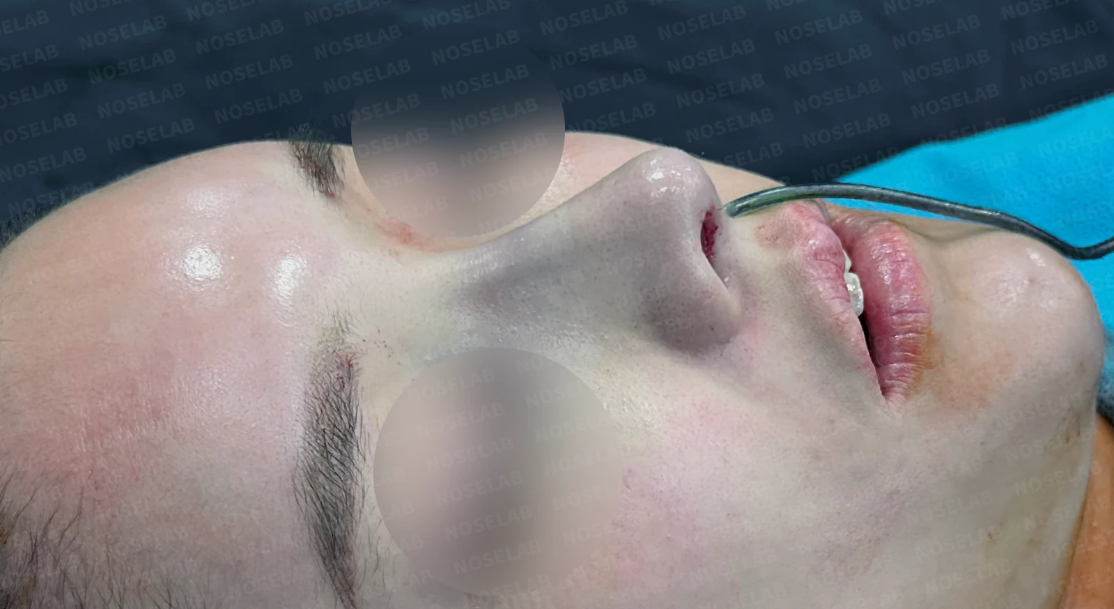 돌출입과 비순각을 함께 살펴보는 코성형 계획 — 수술 전 / 수술 직후 0일 직후 사진은 부기가 있는 상태로 최종 결과와 다를 수 있습니다.