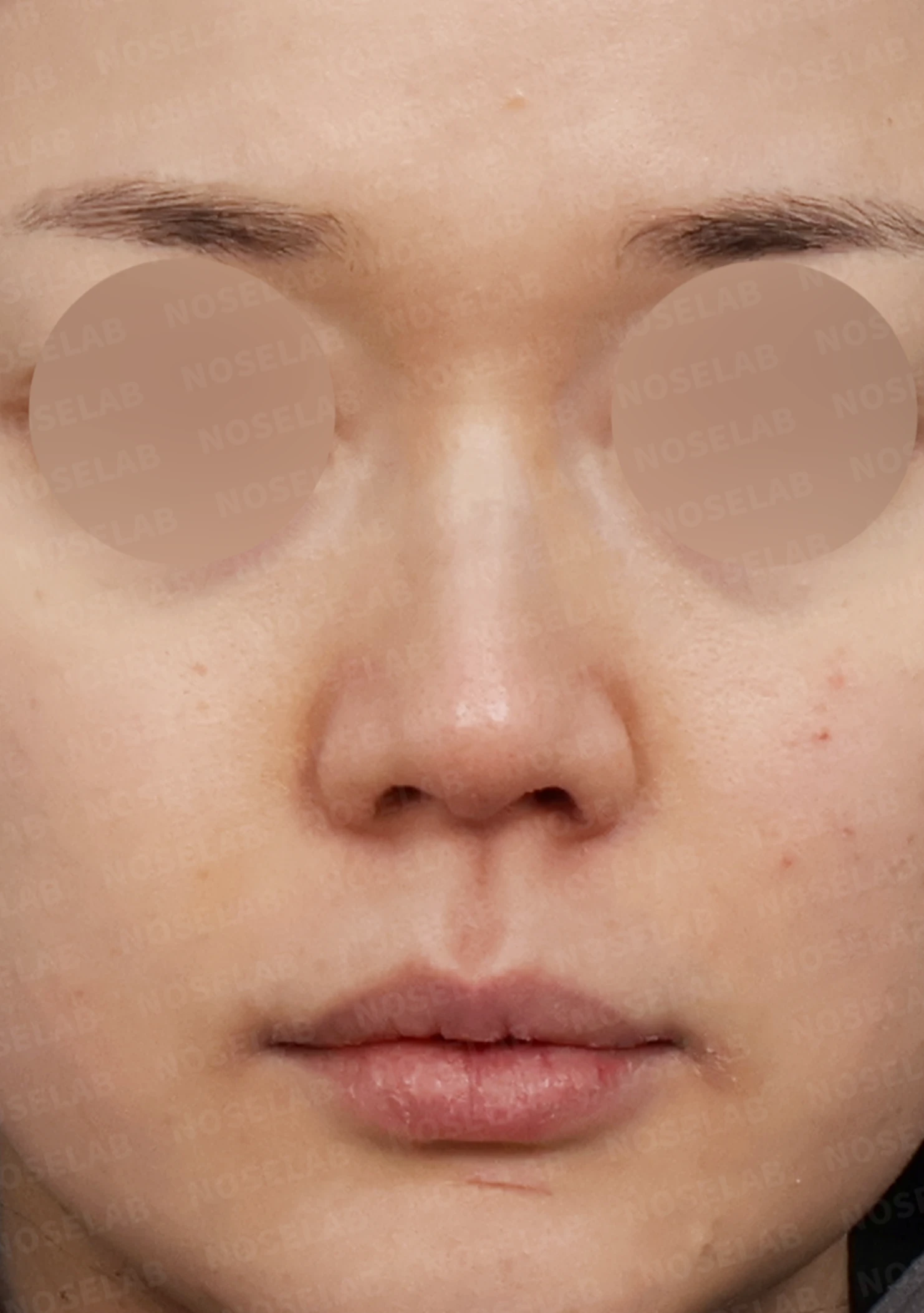 매부리코 교정, 처진 코끝을 오똑하게 바꾸는 비개방 코성형 — 전(좌) 직후(후)