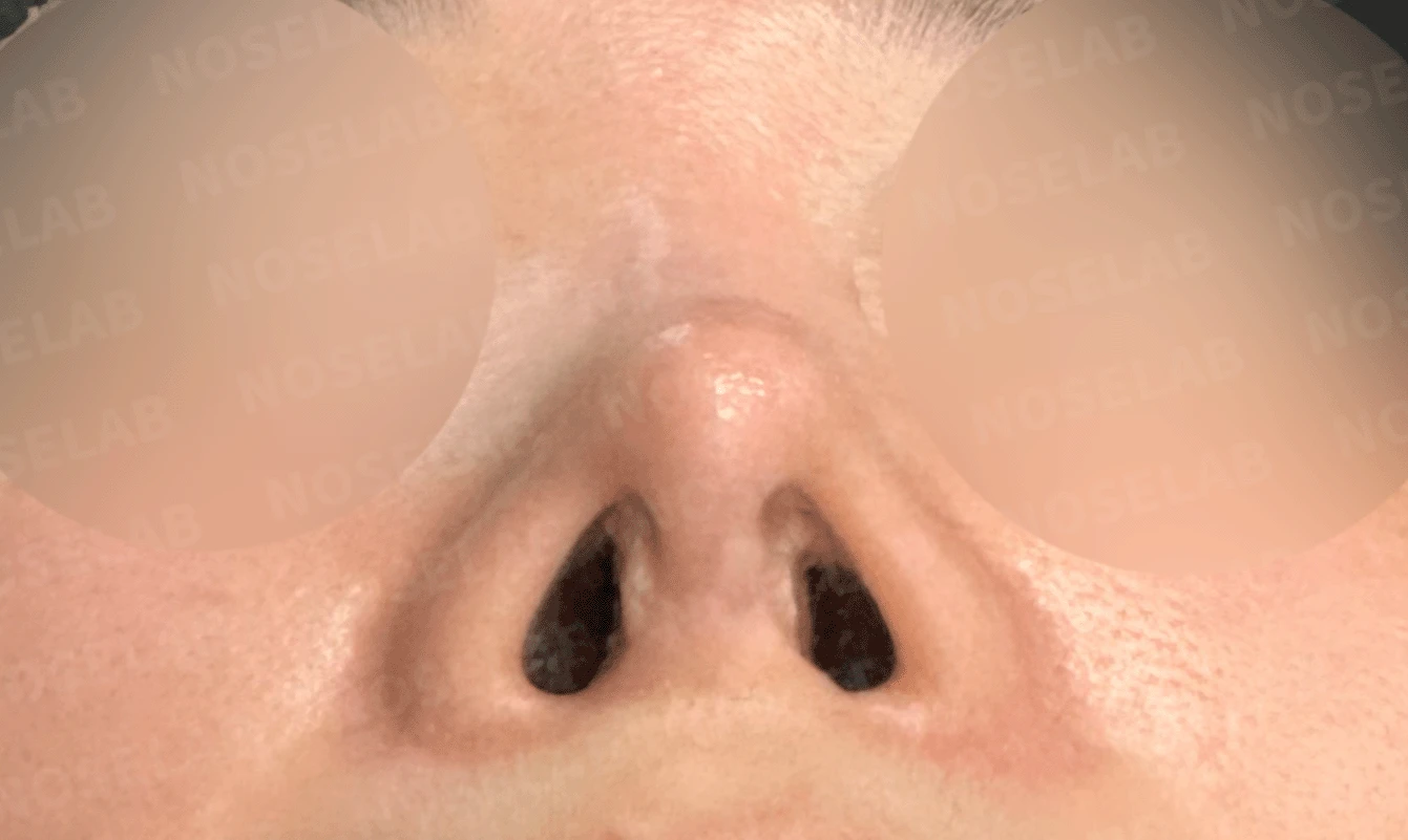 반복된 코재수술 뒤 안장코와 비밸브 협착이 생기는 이유, 전체 재건은 어떻게 하나 — 본문 사진 13