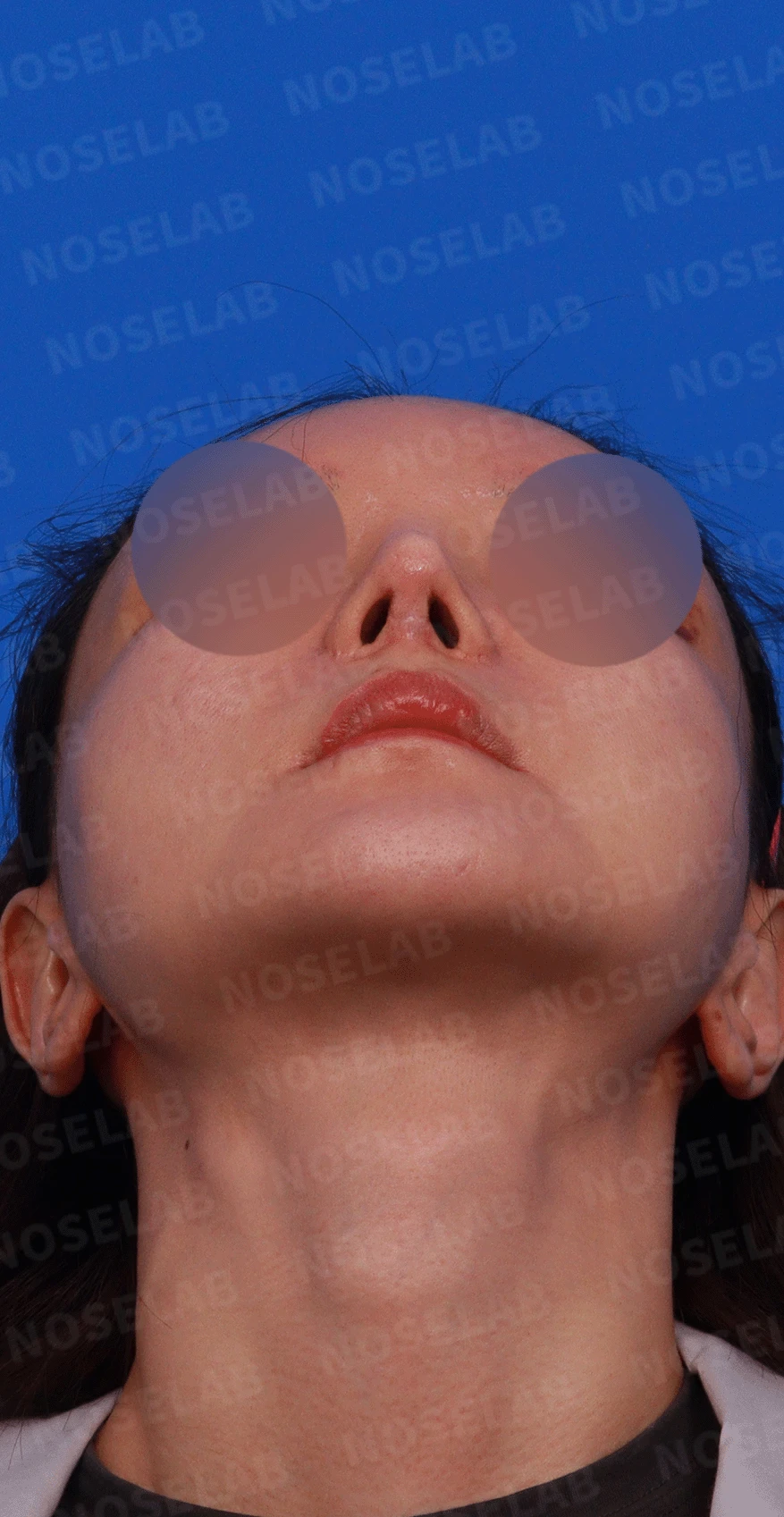 여러 차례 재수술로 코에 쓸 연골이 남지 않았을 때, 재건은 어떻게 하나 — 디자인 상담 우측 측면 , 비스듬한 측면 , 비공 사진입니다.