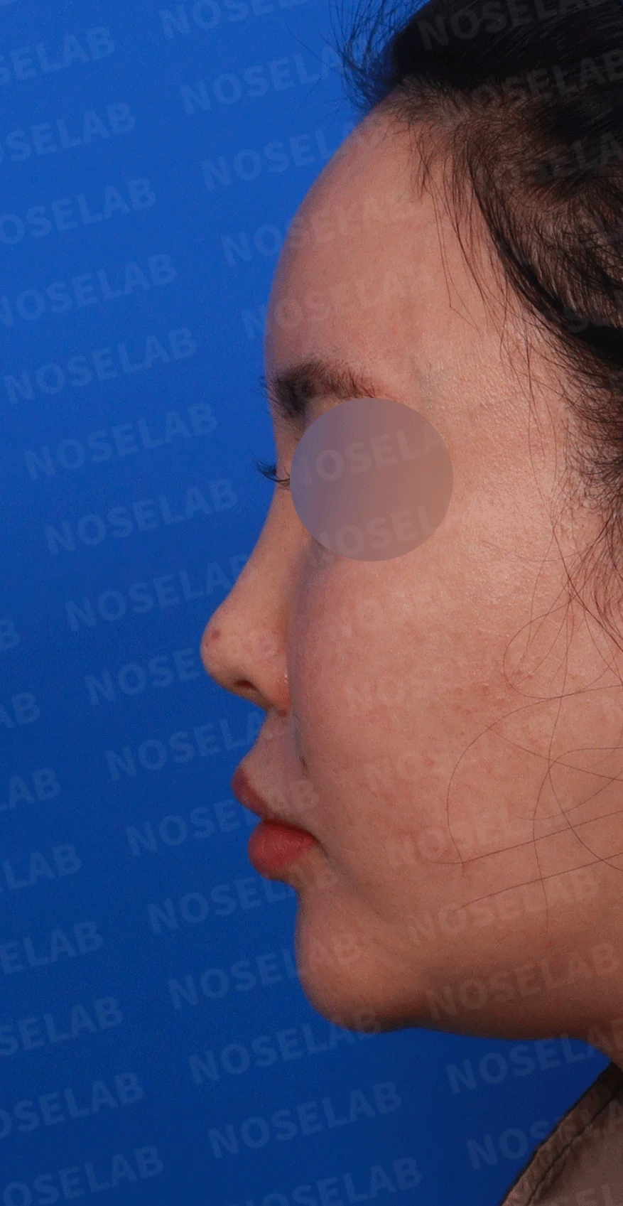 제거했다던 주사 이물질이 남는 이유와 들린 코끝 교정 방법 — 디자인 상담 정면, 좌측 , 비스듬한 측면 , 측면 사진입니다.