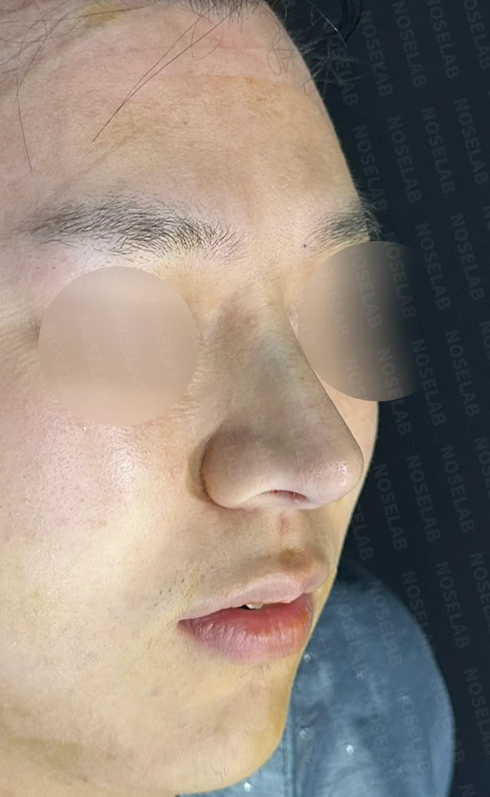 코막힘과 복코를 함께 살펴보는 교정 방법 — 수술 직후 0일 정면, 측면, 비스듬한 측면 사진 직후 사진은 부기가 있는 상태로 최종 결과와 다를 수 있습니다.