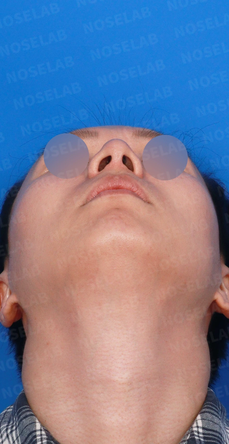 한쪽 비골이 함몰되면 왜 코가 휘어 보이는가, 절골 복원과 비중격 재건 — 디자인 상담 우측 측면, 비스듬한 측면, 비공 사진
