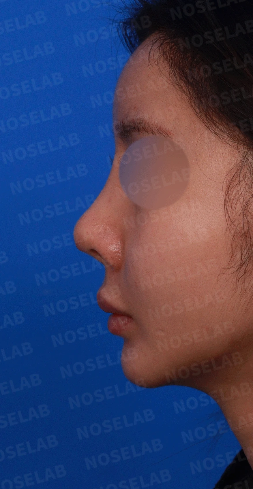 실리콘 보형물이 코끝 피부를 뚫고 나오려 할 때, 왜 생기고 어떻게 재건하나 — 디자인 상담 정면, 좌측 측면, 비스듬한 측면 사진