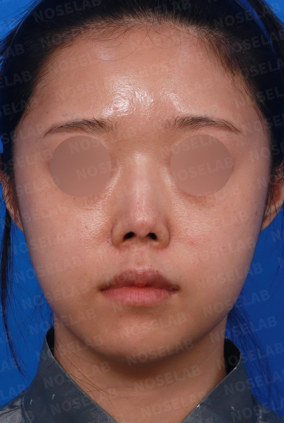 코끝 피부가 얇아져 연골이 비치는 이유, 피부 보강은 어떻게 하나 — 디자인 상담 정면, 좌측 측면, 비스듬한 측면 사진입니다.