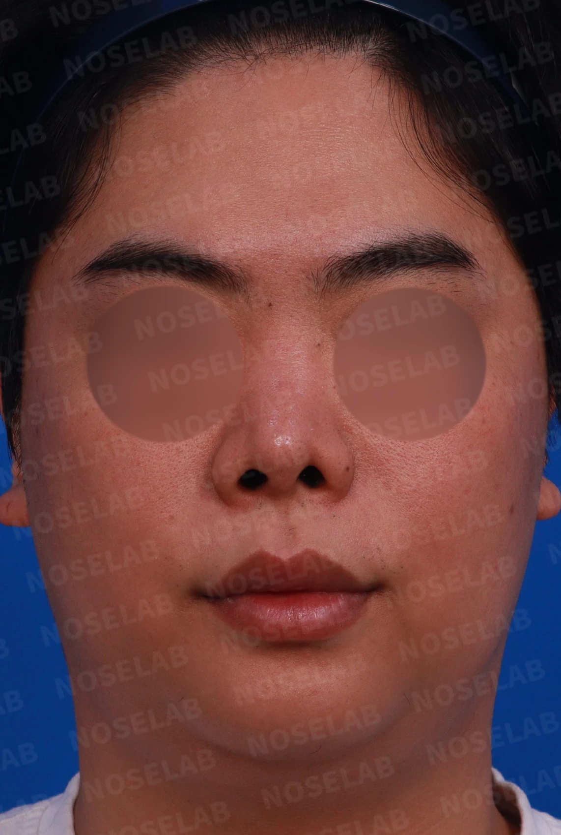 들린 코와 코막힘, 늑연골로 지지 구조를 재건하는 방법 — 디자인 상담 정면, 좌측 측면, 비스듬한 측면 사진
