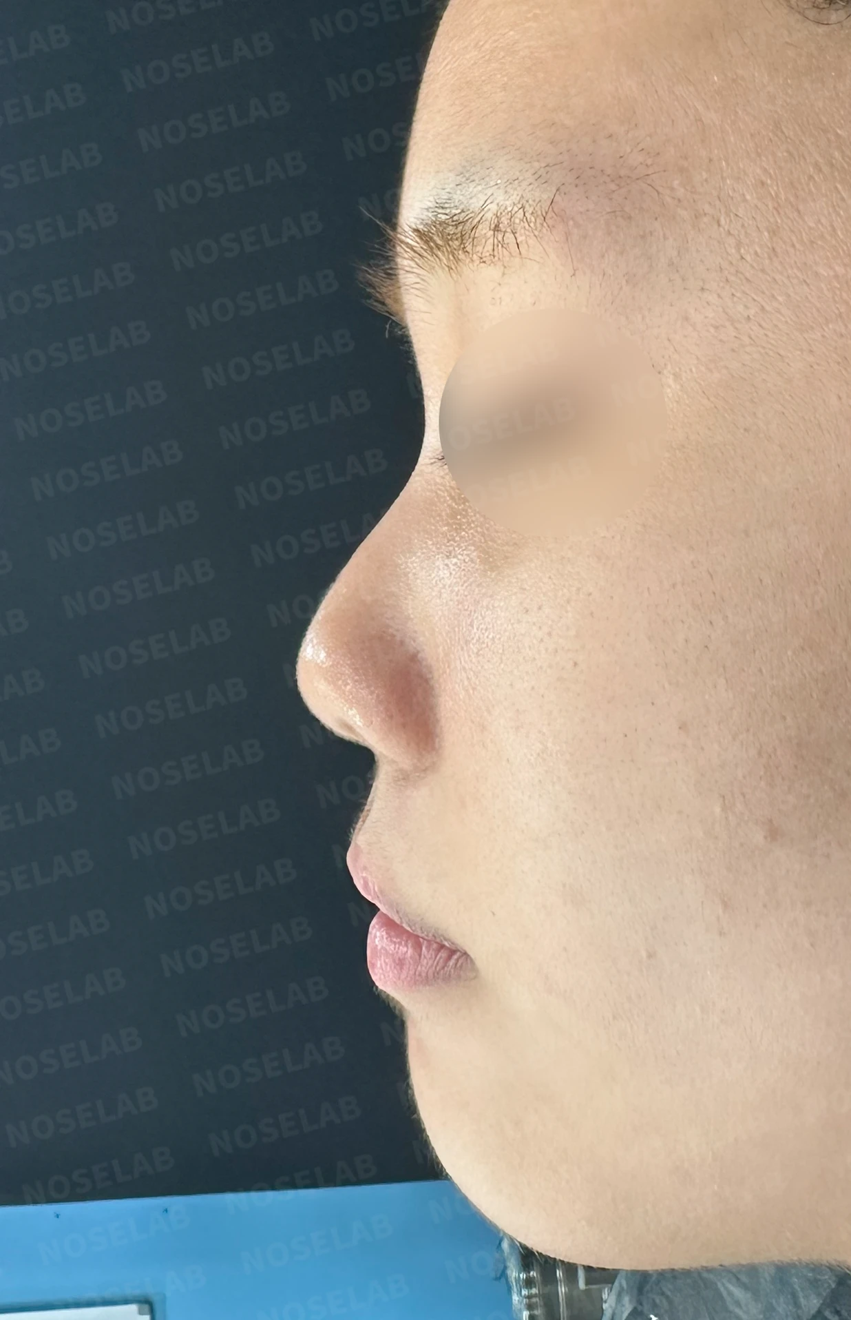 작고 뭉툭한 코는 어디까지 높일 수 있나 — 피부의 한계와 재건 방법 — 수술 전 / 수술 직후 0일 직후 사진은 부기가 있는 상태로 최종 결과와 다를 수 있습니다.