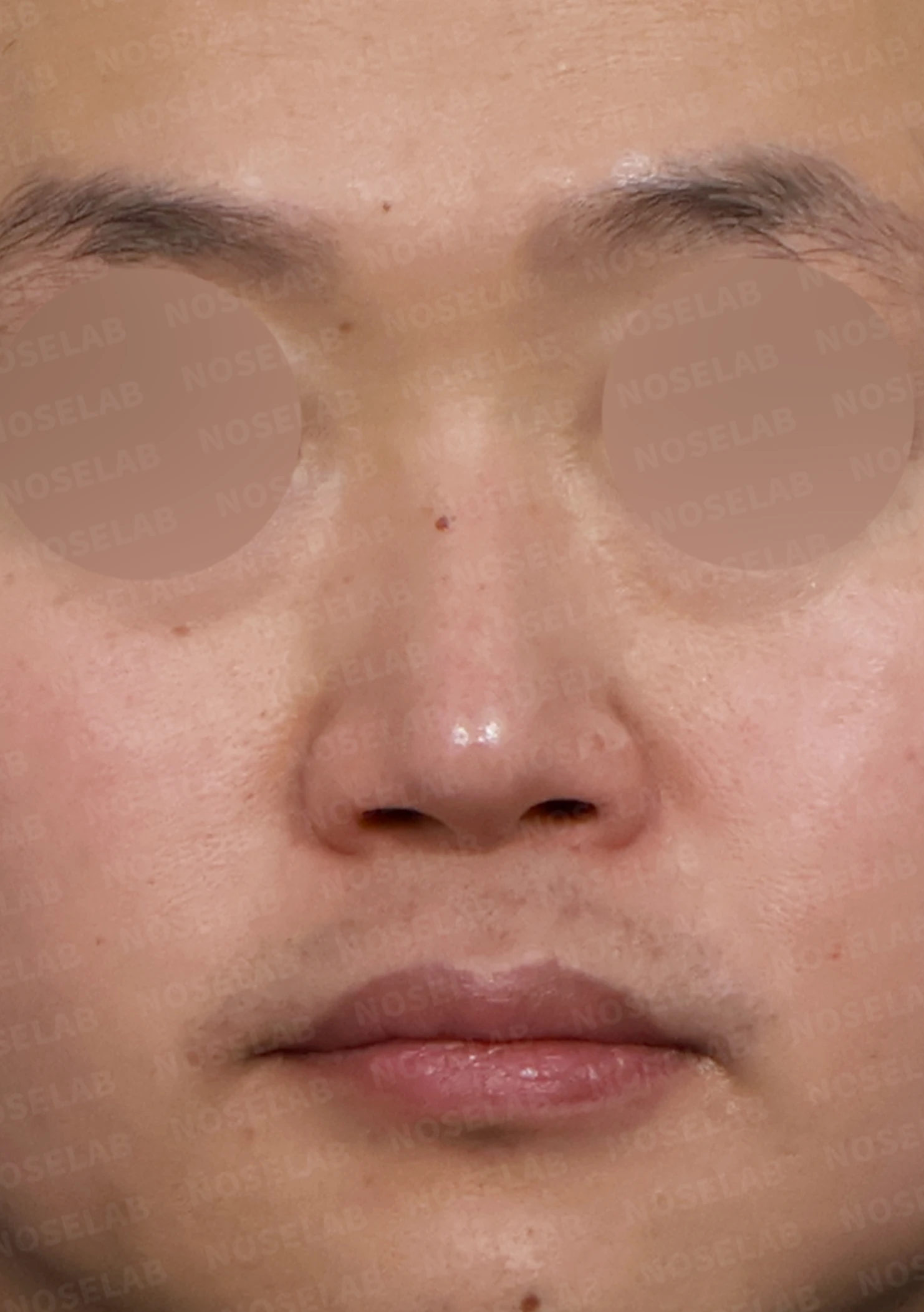 코막힘과 휘어진 비중격, 자가늑연골로 기능과 모양을 동시에 개선 — 전(좌) 직후(후)