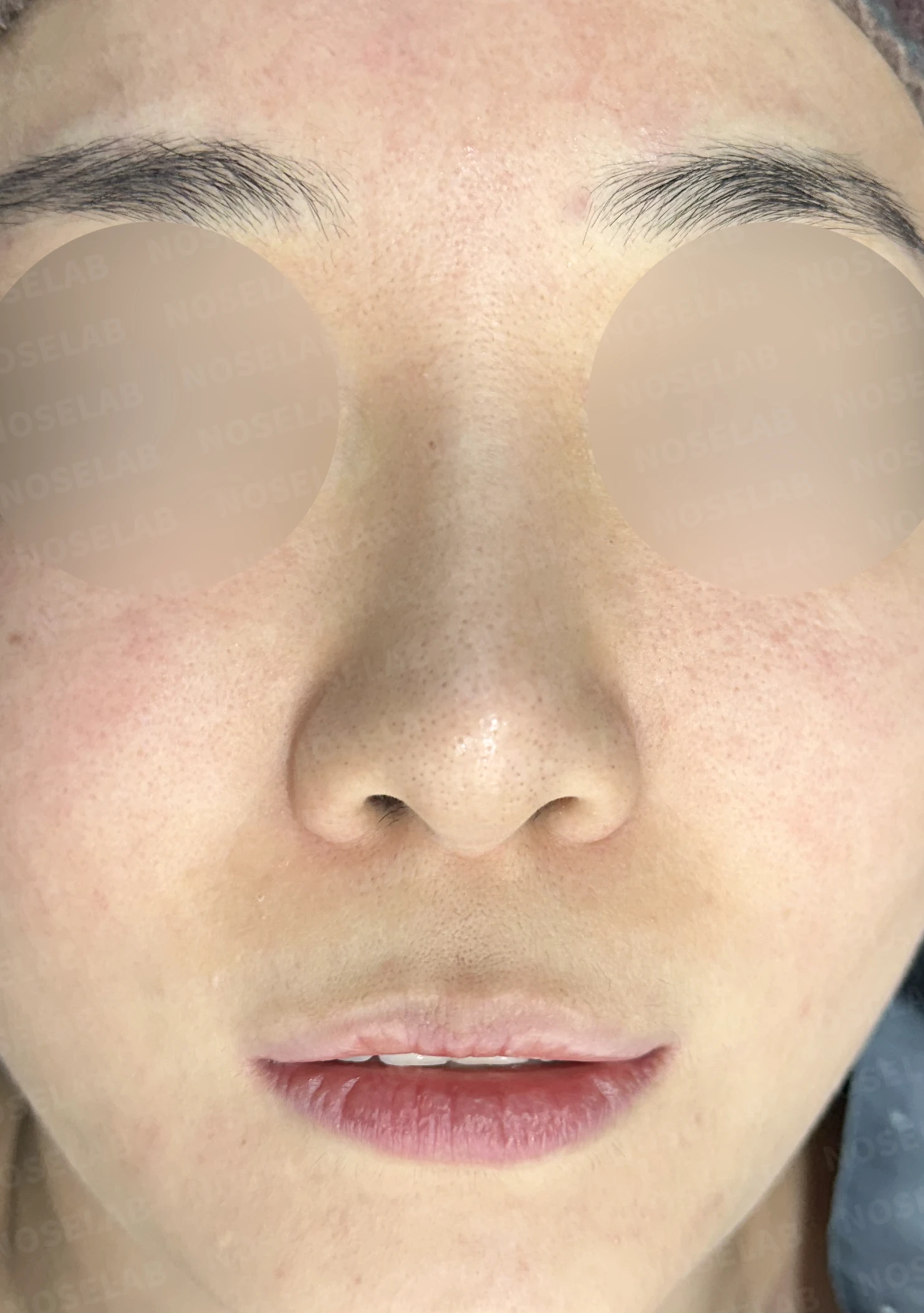 L자 보형물 제거 후 자가 늑연골로 코끝을 교정한 코재수술 — 전(좌) 직후(후)