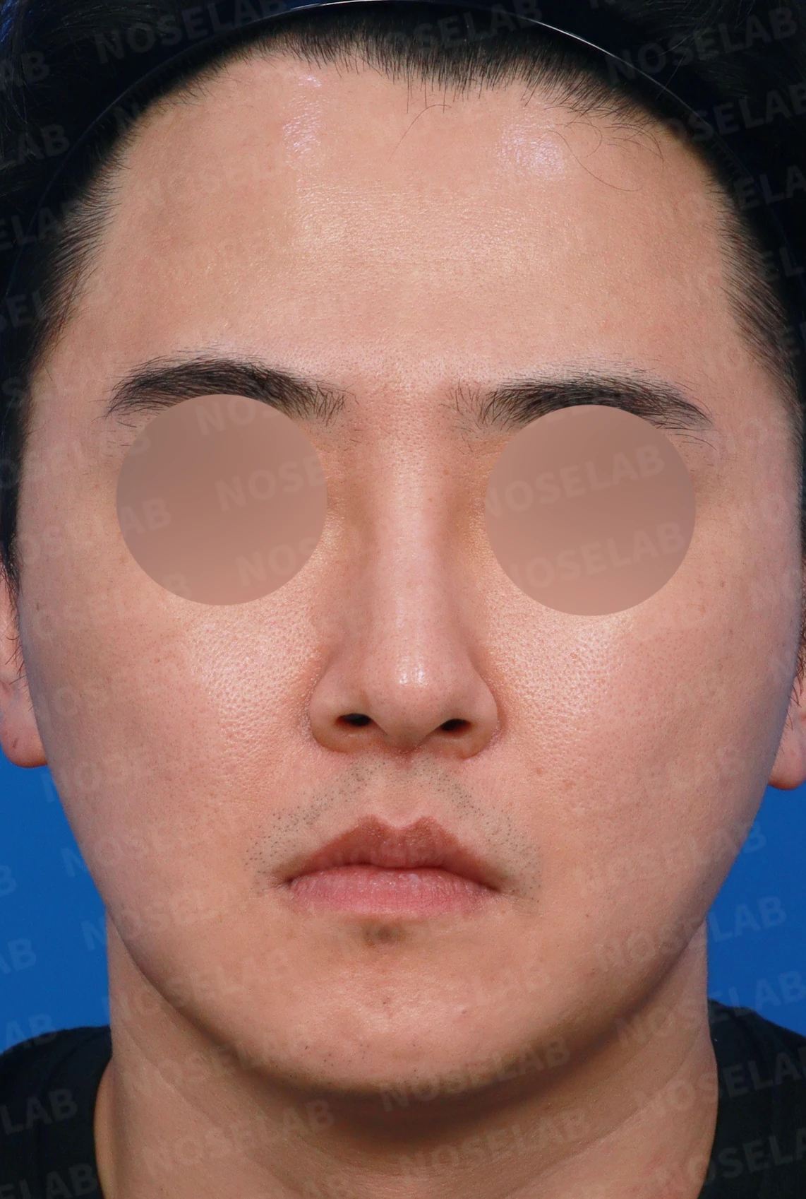 안면 비대칭이 있는 코를 교정할 때 얼굴 축을 먼저 보는 이유 — 디자인 상담 정면, 좌측 측면, 비스듬한 측면 사진입니다.