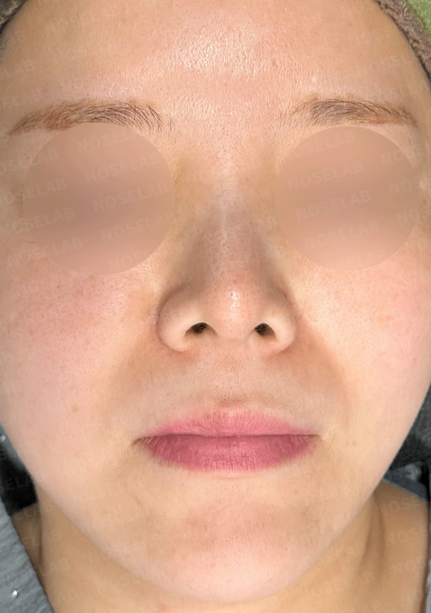 늑연골 석회화를 미리 확인해야 하는 이유와 휜코·짧은코 교정 방법 — 본문 사진 7