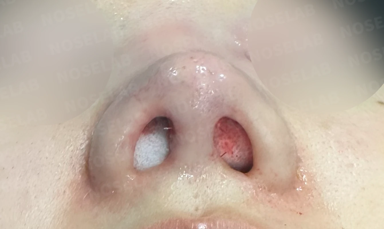 비공 비대칭과 코끝 처짐은 왜 생기나, 연골을 병용한 재건 방법 — 진수술 직후 0일 비공 사진 직후 사진은 부기가 있는 상태로 최종 결과와 다를 수 있습니다.