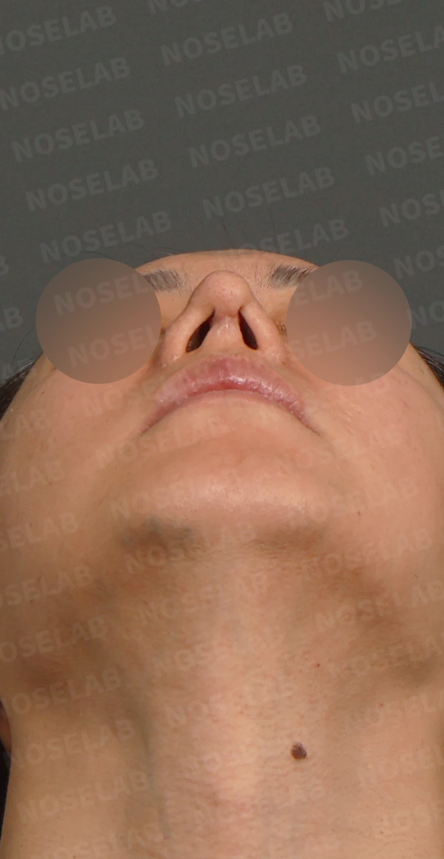 여러 차례 코재수술 후 구축 변형, 자가늑연골로 재건한 사례 — 디자인 상담 우측 측면, 비스듬한 측면, 비공 사진입니다.