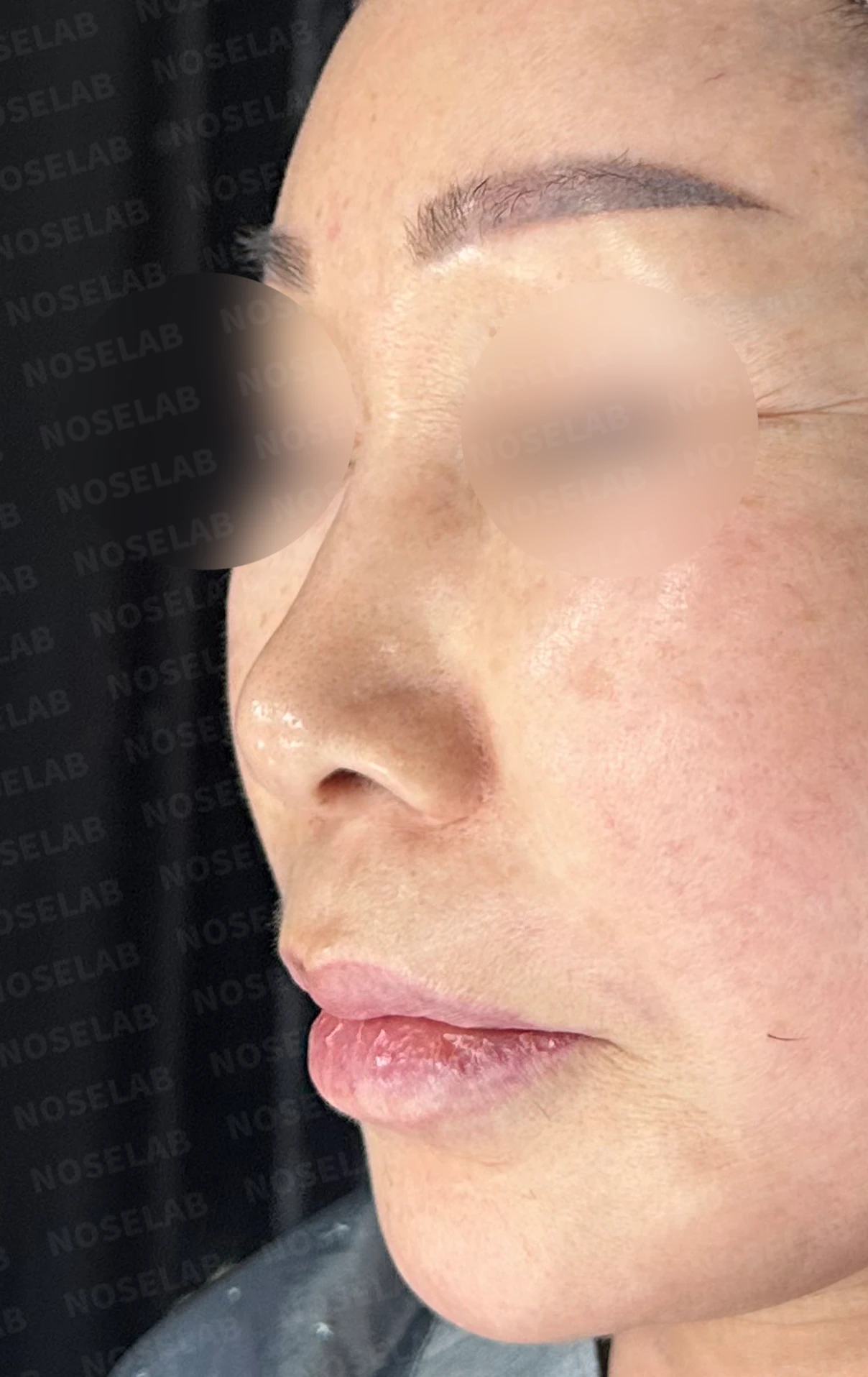 코 안에 남은 메드포어와 이물질, 왜 문제가 되고 어떻게 제거하나 — 수술 전 / 수술 직후 0일 직후 사진은 부기가 있는 상태로 최종 결과와 다를 수 있습니다.